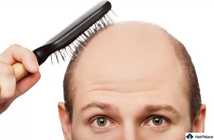 la forfora raramente porta alla caduta dei capelli o alla calvizie