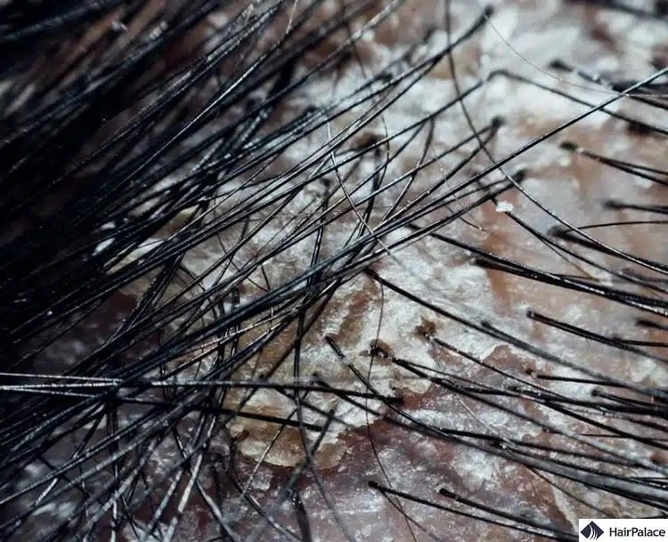 la forfora può essere una condizione fastidiosa da affrontare e può causare prurito al cuoio capelluto