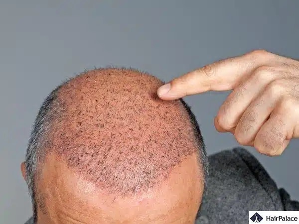 trapianto di capelli su tutta la testa