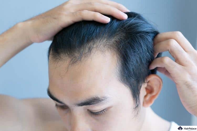 i primi segni di caduta dei capelli possono manifestarsi intorno ai 20 anni