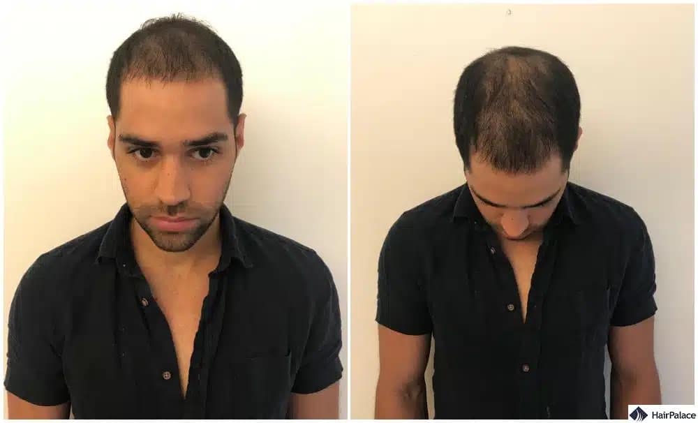 la crescita dei capelli avverrà tre mesi dopo il trapianto di capelli