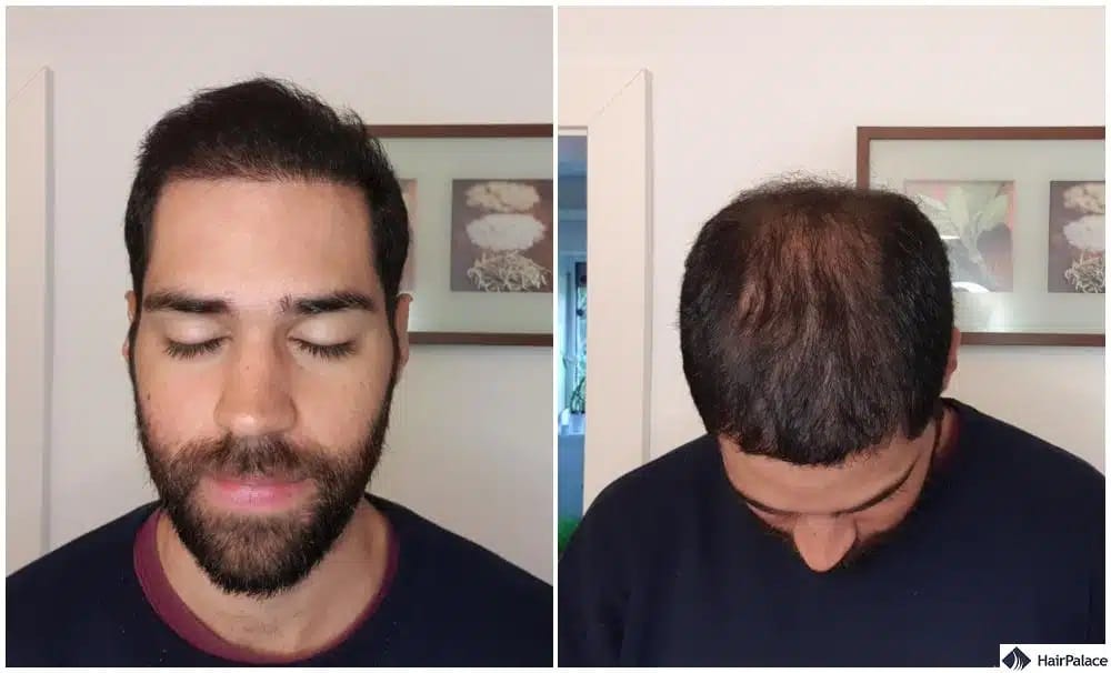 i tuoi capelli dovrebbero continuare ad ispessirsi a un buon ritmo 6 mesi dopo un trapianto di capelli