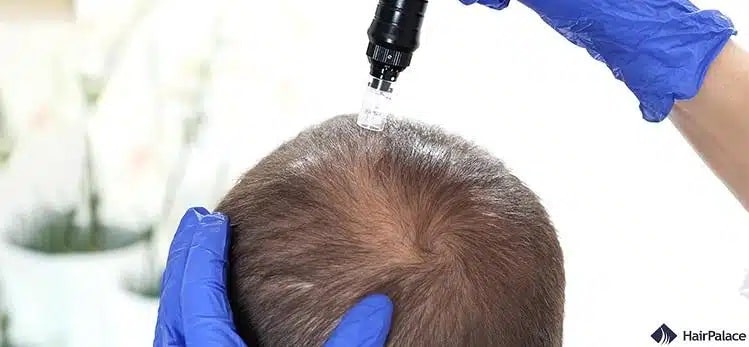 Il microneedling ha diversi vantaggi per i tuoi capelli