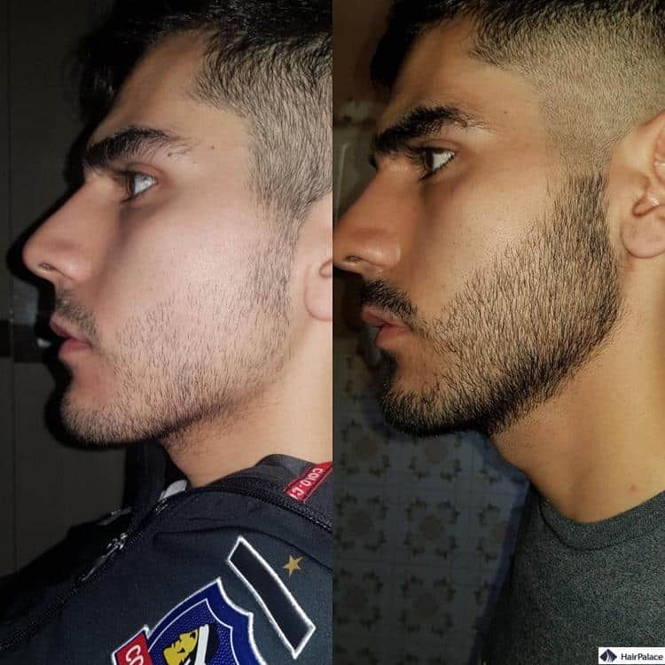 dermaroller barba risultato