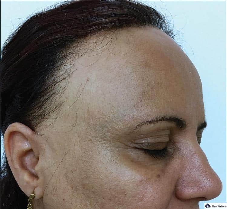 L'alopecia fibrosa frontale è una malattia dermatologica che causa la perdita di capelli nella regione frontale e la recessione dell'attaccatura.