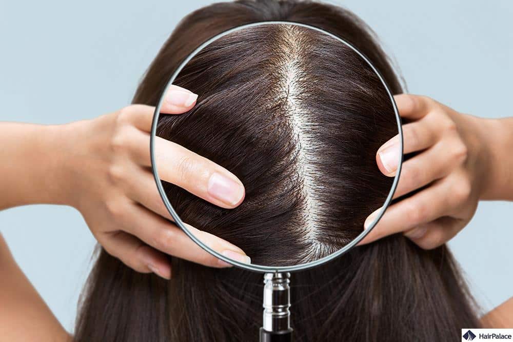 esame della caduta dei capelli con specialisti dei capelli