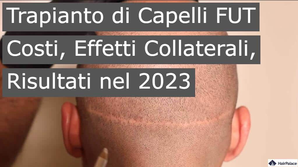 Trapianto di capelli FUT costi effetti collaterali risultati nel 2023