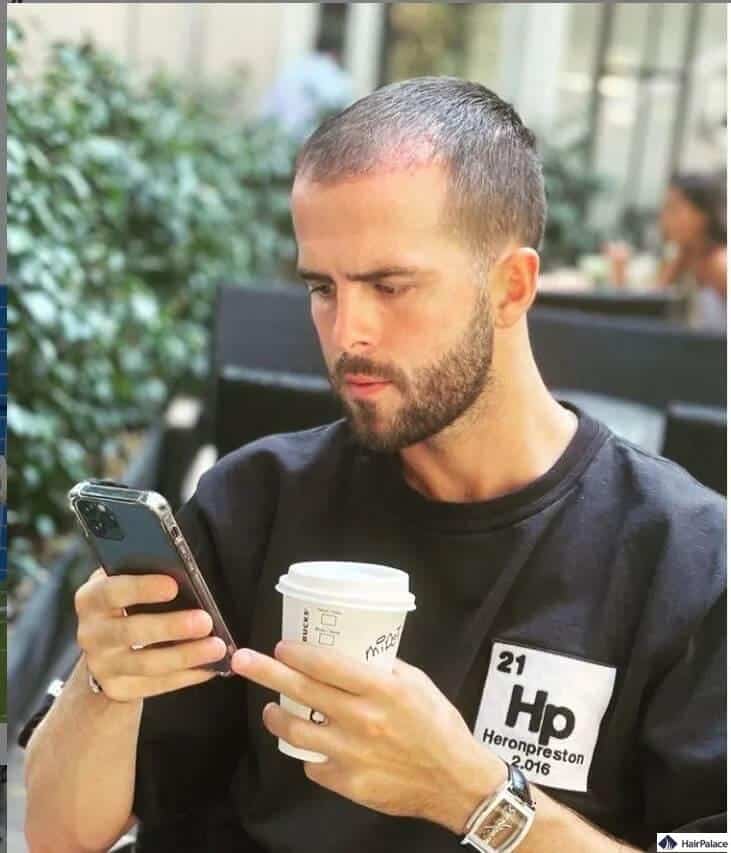 calvizie di pjanic