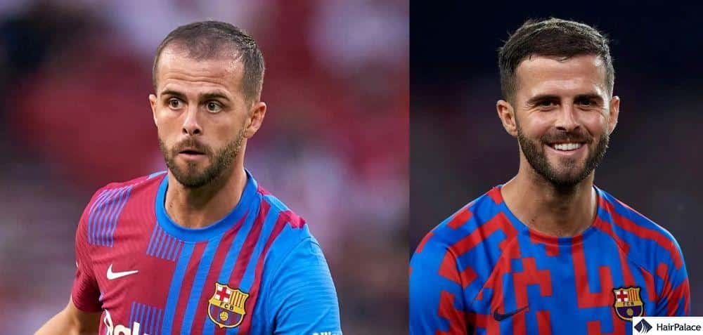 miralem pjanic prima e dopo il trapianto di capelli