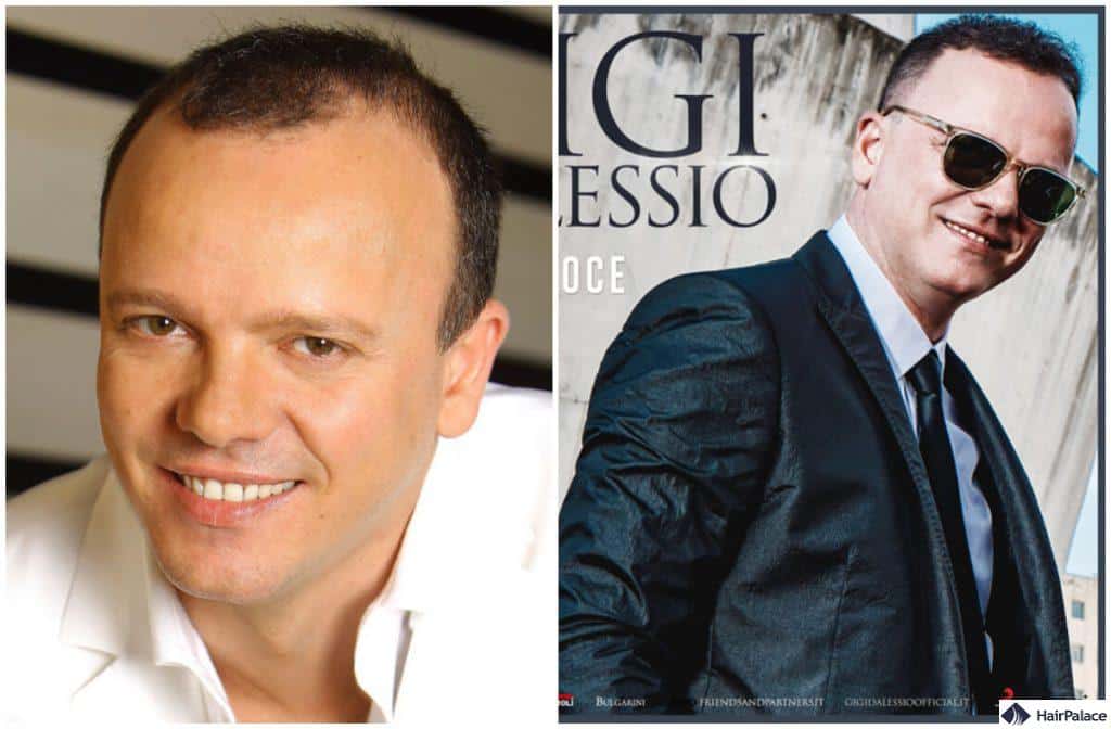 gigi d'alessio risultati finali del trapianto di capelli